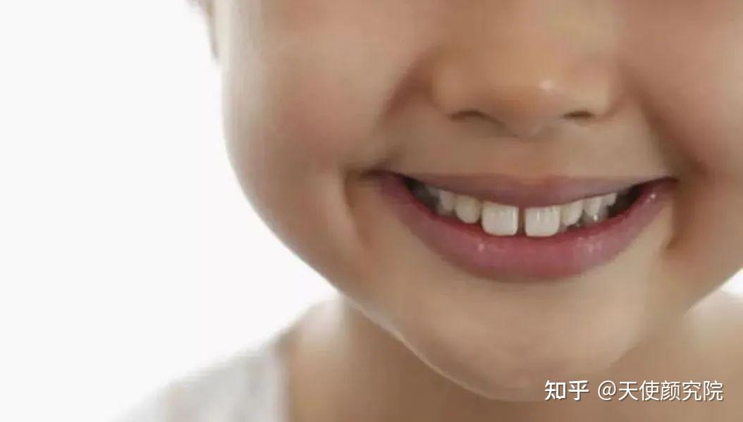 二,孩子凸嘴的自测方法