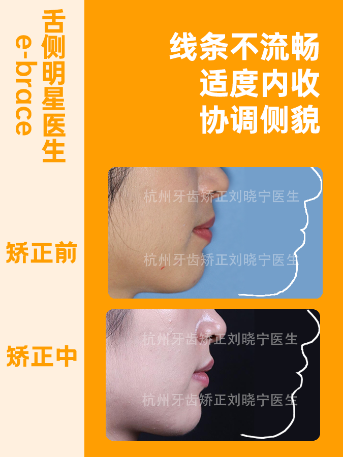 杭州隐适美矫正丨微翘的上唇更显年轻态,也可以对抗增龄性的唇部下垂 - 知乎