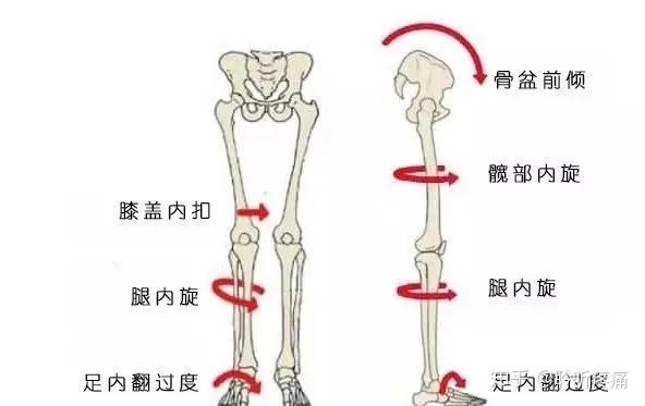 髋骨突出是什么原因图片