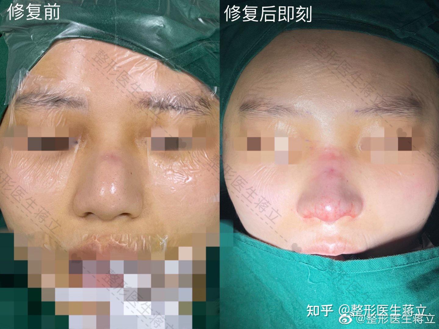 鼻修复膨体感染炎症导致鼻背皮肤变薄鼻头大鼻背变宽鼻基底凹陷