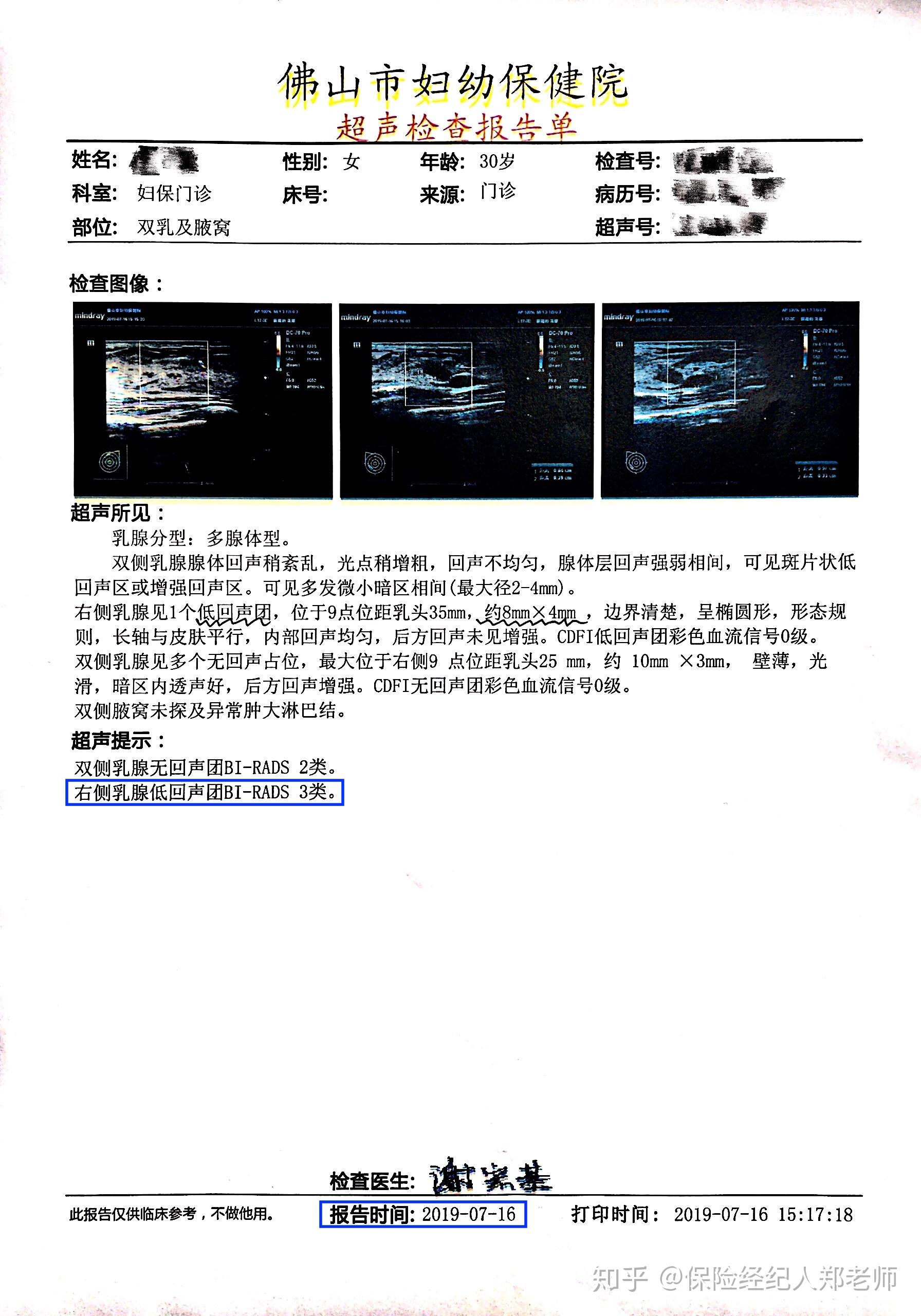 ①客戶病情:31歲女性,5年前醫院體檢發現右側乳腺低迴聲結節,4年前