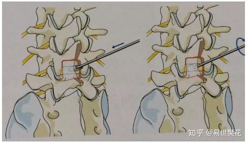 ube 这些差别你知道吗?plf plif tlif dlif xlif 手术技术对比