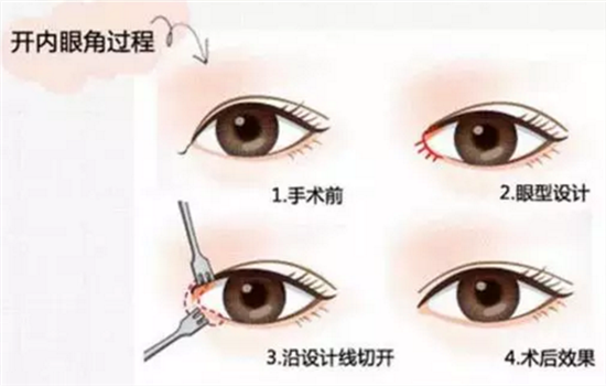 开眼角后两眼距离近能修复吗