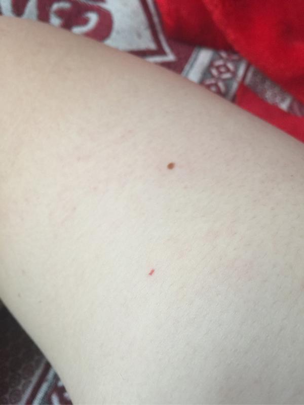 皮肤上面有一些小的血点 像是血不高于皮肤 很小 右胳膊上有很多仔细看 皮肤有红色的小血点