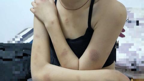 女孩身上,脸上 多处淤青,并且… 阅读全文