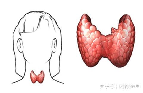 超声提示甲状腺结节有钙化,就是甲状腺癌吗? - 知乎