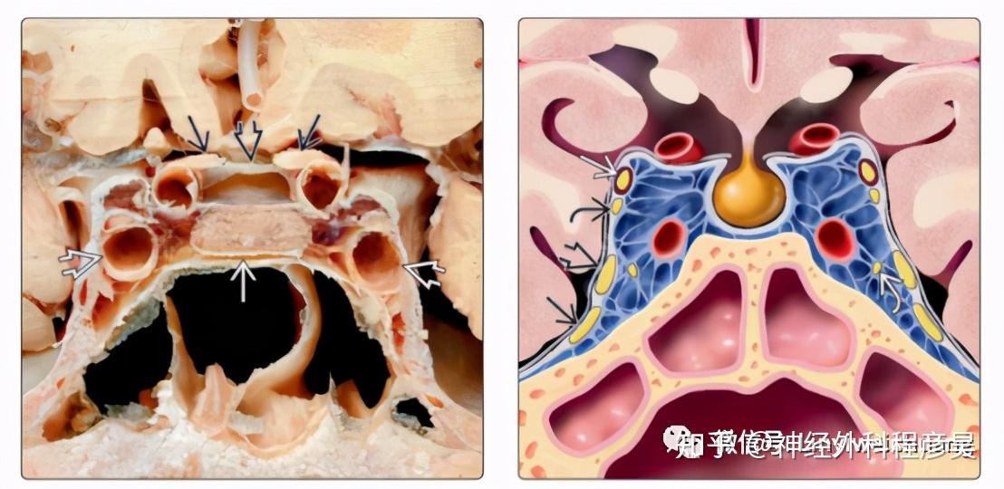 蝶窦 垂体瘤图片