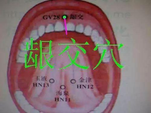 龈交穴治疗痔疮