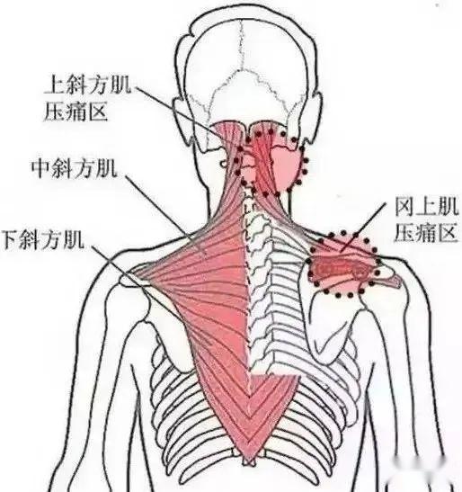 肩胛背神经卡压综合征