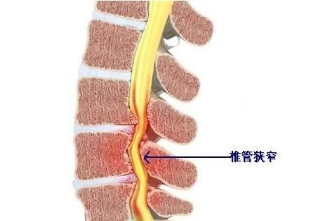 健康科普 腰椎管狭窄症是由于椎管发生骨性或纤维性狭窄,压迫脊髓