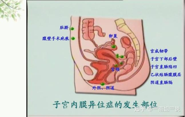 南姐说:探秘妇科疑难杂症之"子宫内膜异位症"的三生三世系列1