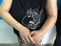 乳腺癌术后手臂淋巴水肿治愈心得