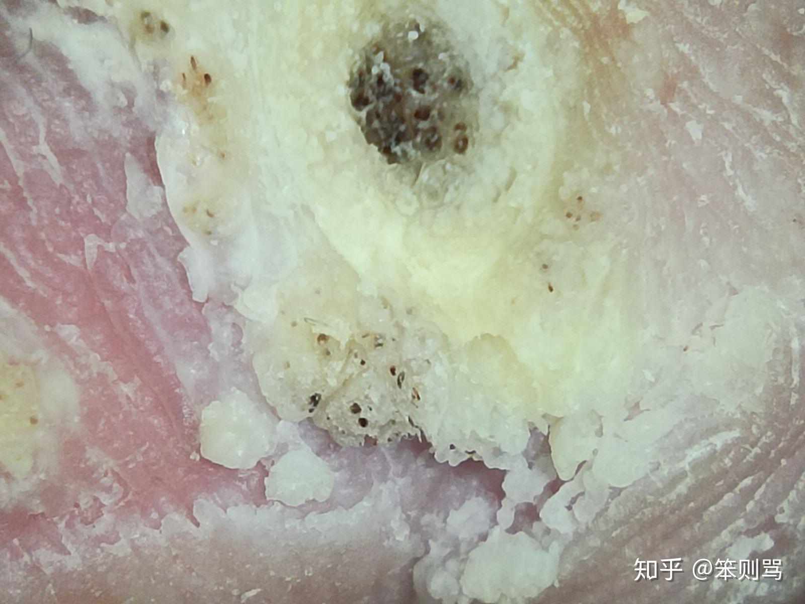 完全真实的跖疣好转过程花费不到一百元