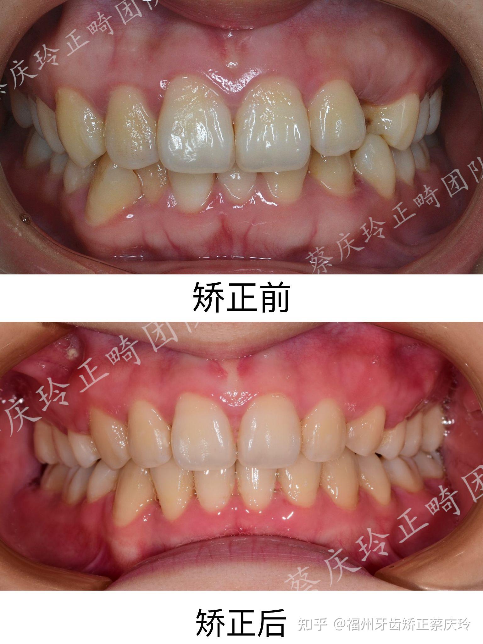 蔡庆玲正畸团队缺牙深覆合案例