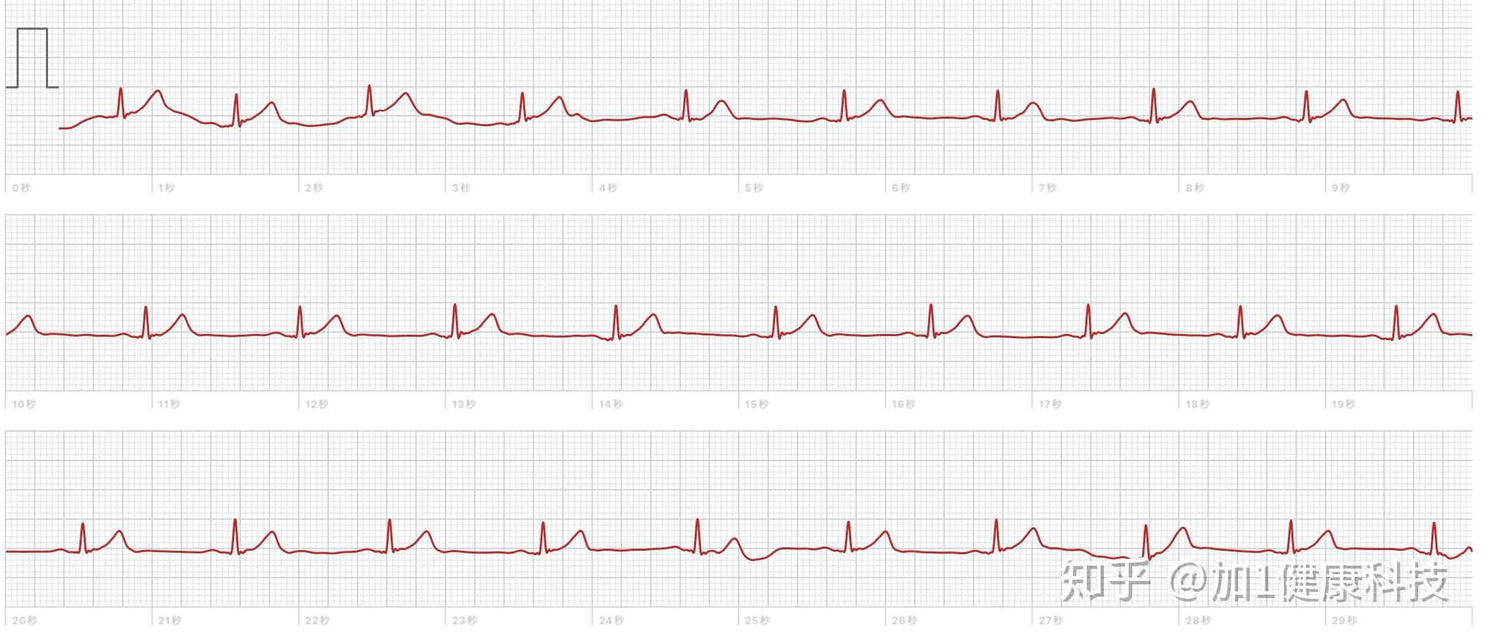 如何激活国行apple watch 苹果手表的ecg心电图,开通ecg心电图功能