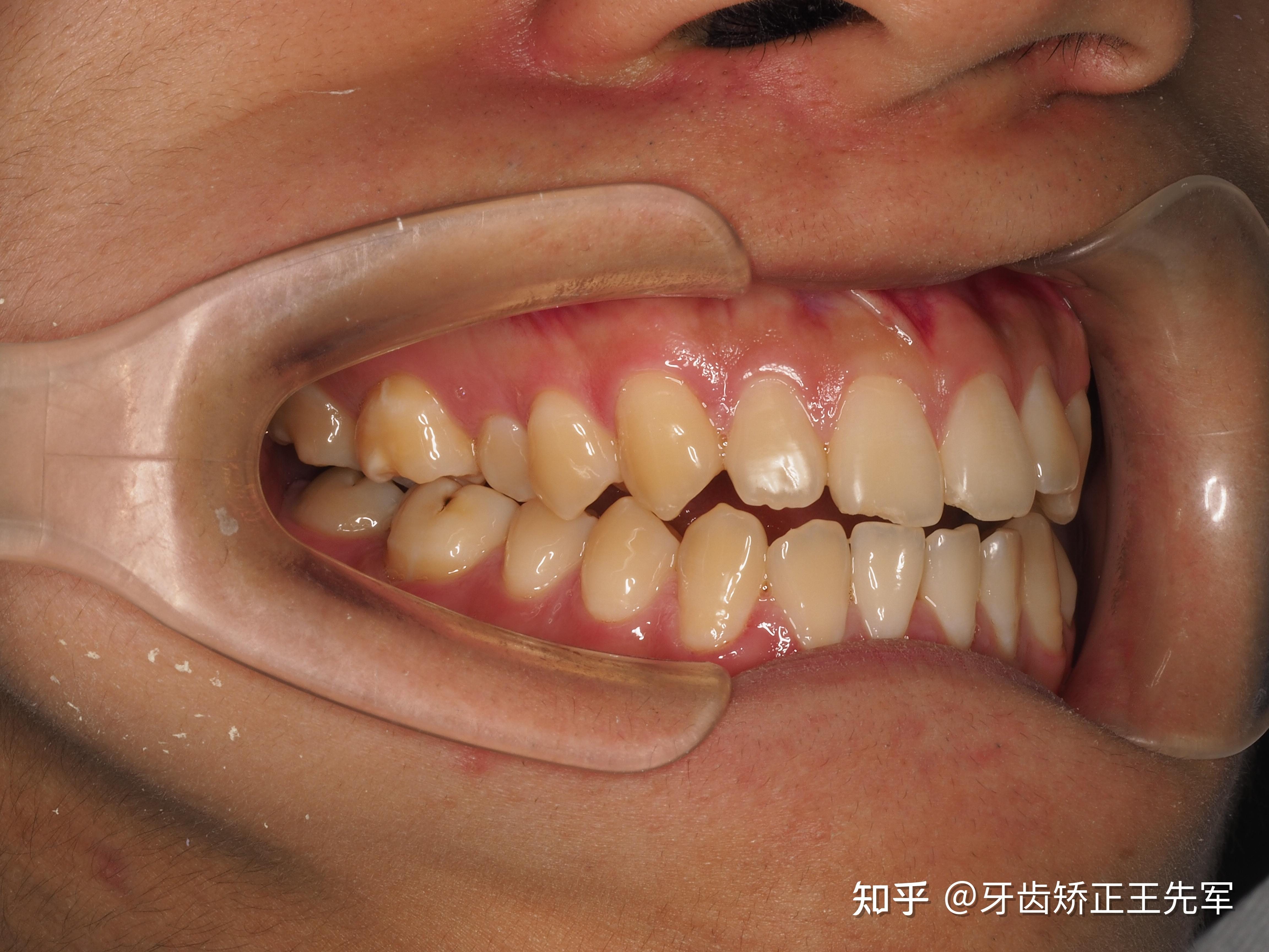 苏州正畸-隐适美牙齿矫正案例分享