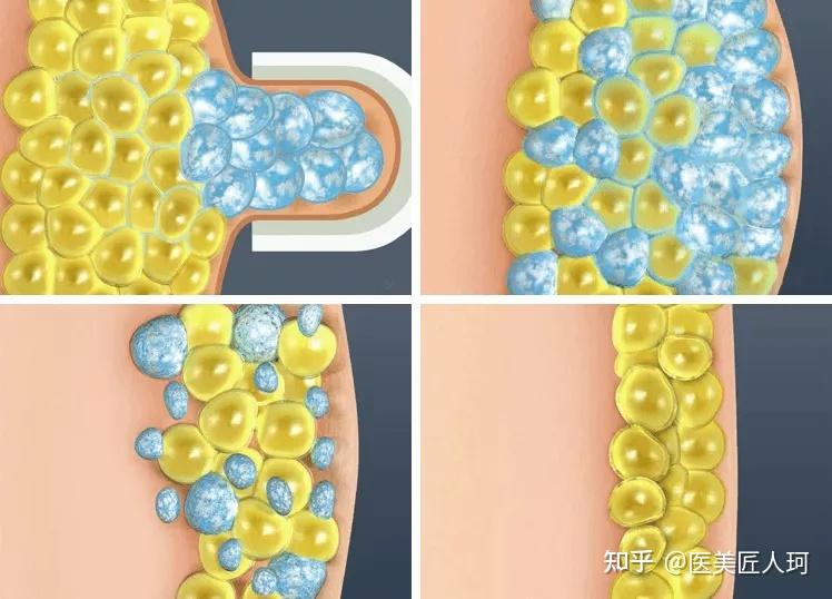 黑科技实现局部减脂冷冻溶脂为什么这么香