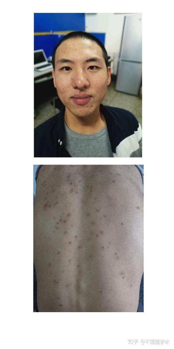 成人得水痘的经历-25岁 - 知乎