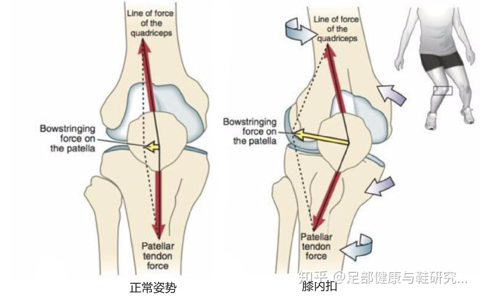 正常情况下,髌骨也俗称"膝盖骨"就像水滑梯里的小朋友一样,沿着正确的