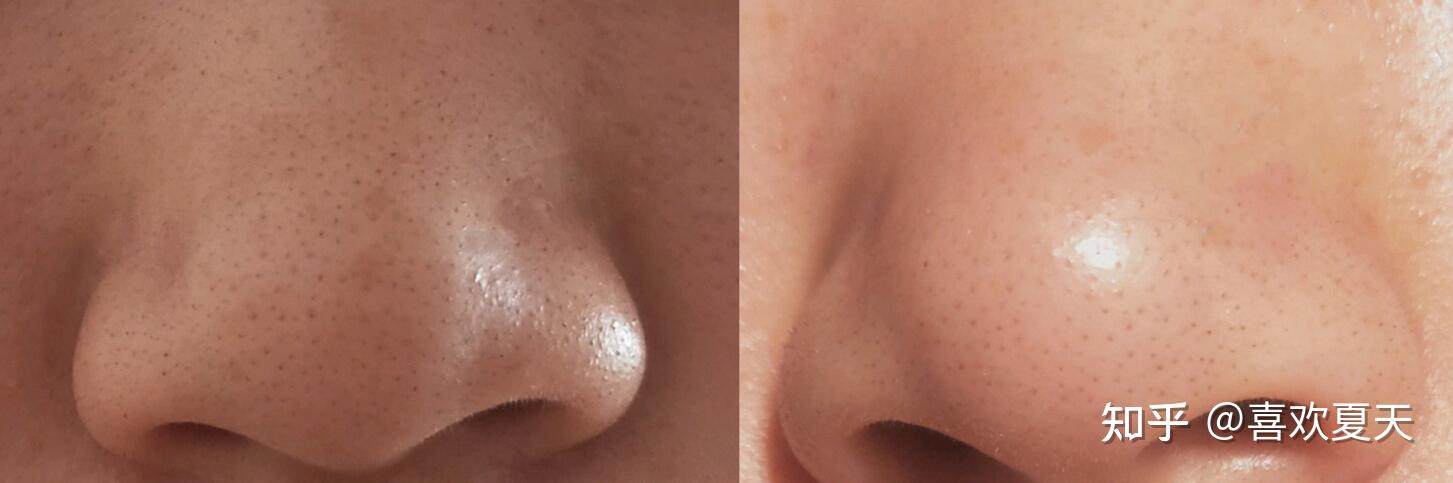 我鼻子太多黑头了,超级多,草莓一样,毛孔很大,挤得出白色的,恶心,怎么