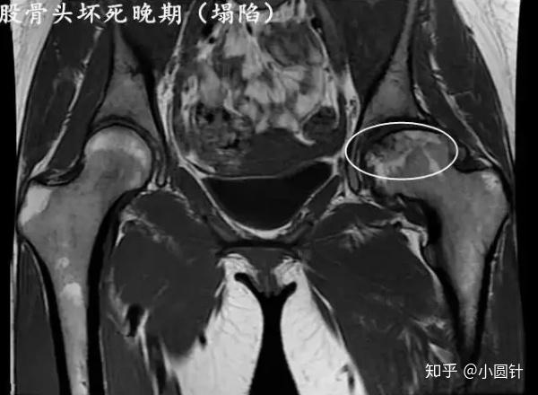 股骨头坏死新月征图片