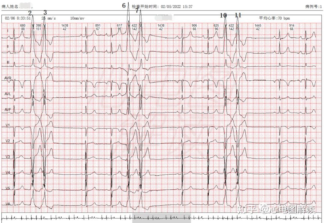 室性早搏二联律,成对室性早搏