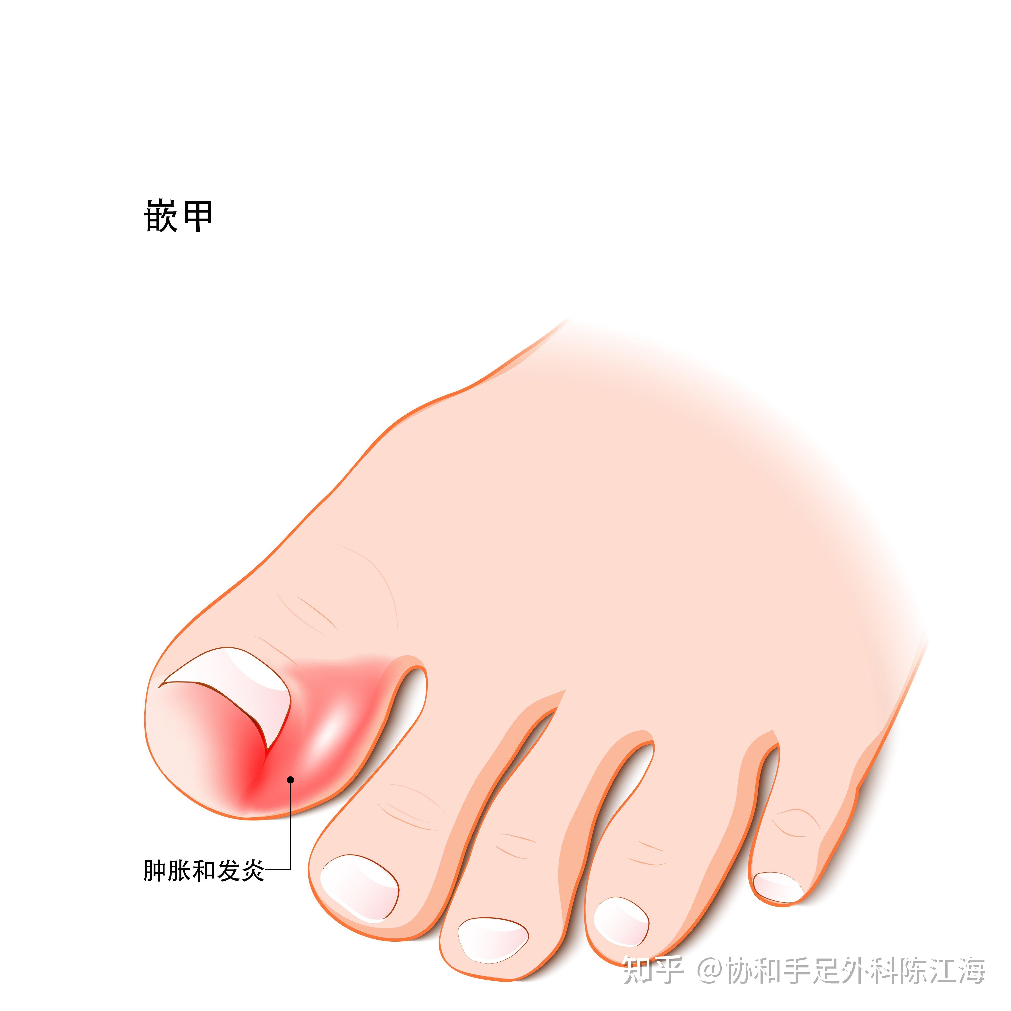 拔甲为什么还会感染嵌甲?怎么预防?