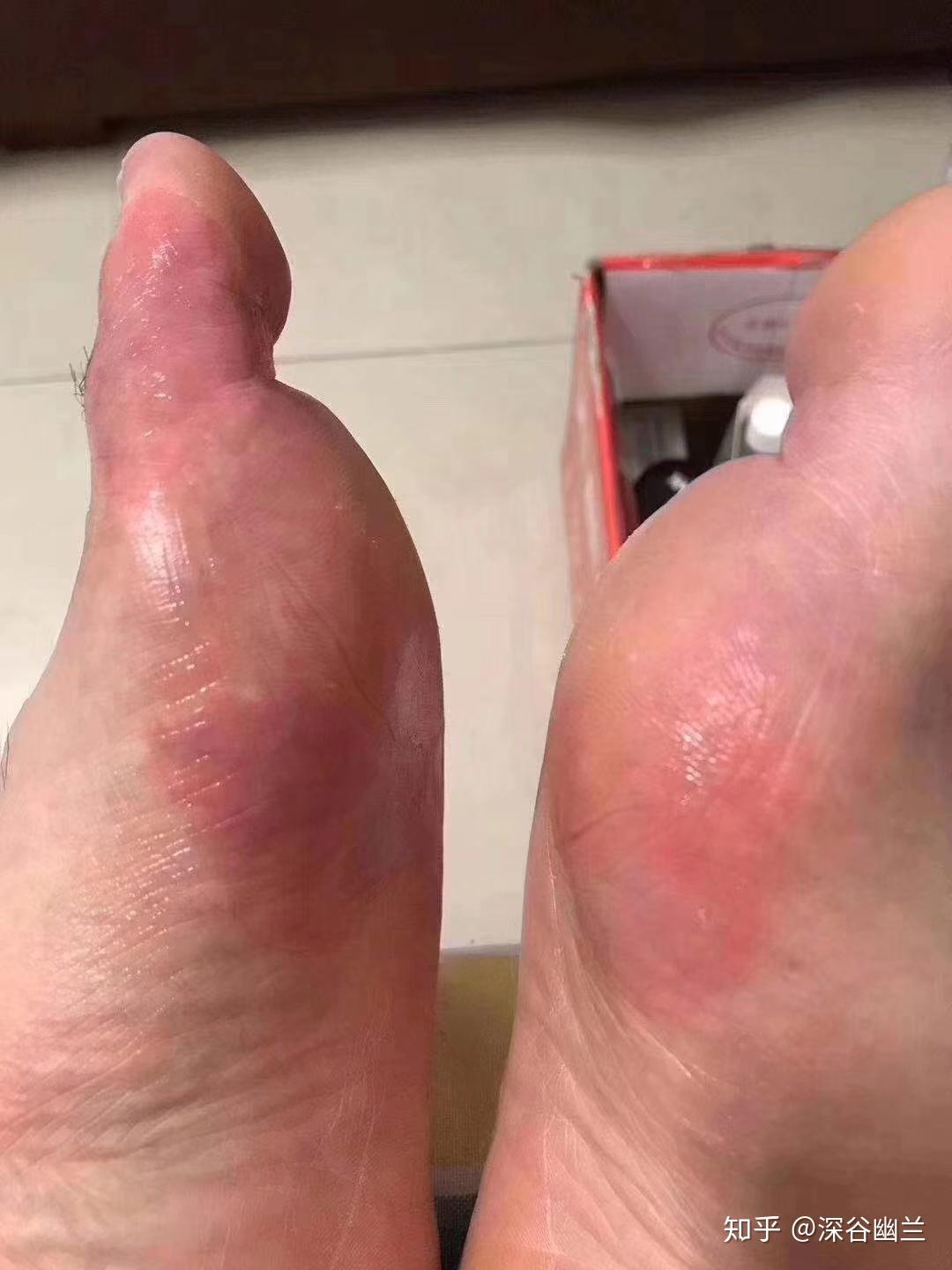 6年脚气脚臭王如何45天逆袭脚模天使听大三女生自述