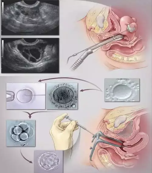 试管流程移植胚胎移植流程及注意事项