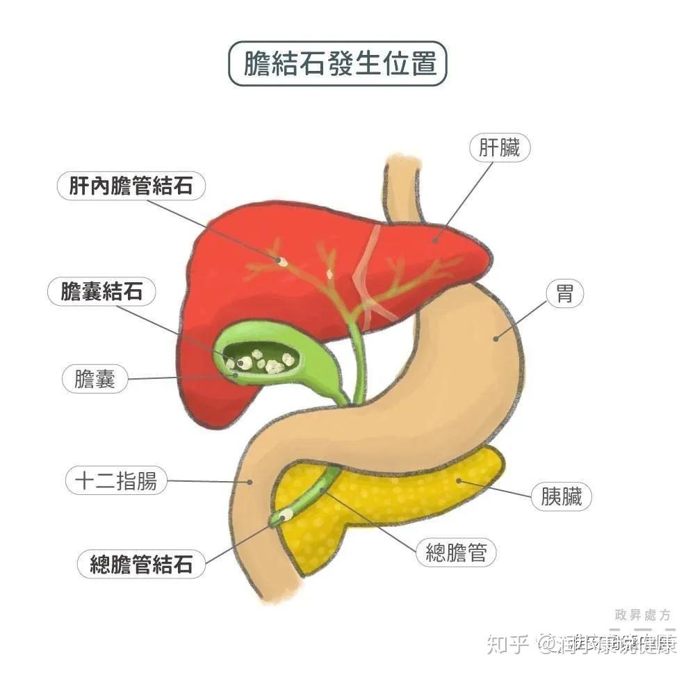 或晚上摄入高脂肪餐后不活动,导致临睡前胃及十二指肠积食,是引起胆