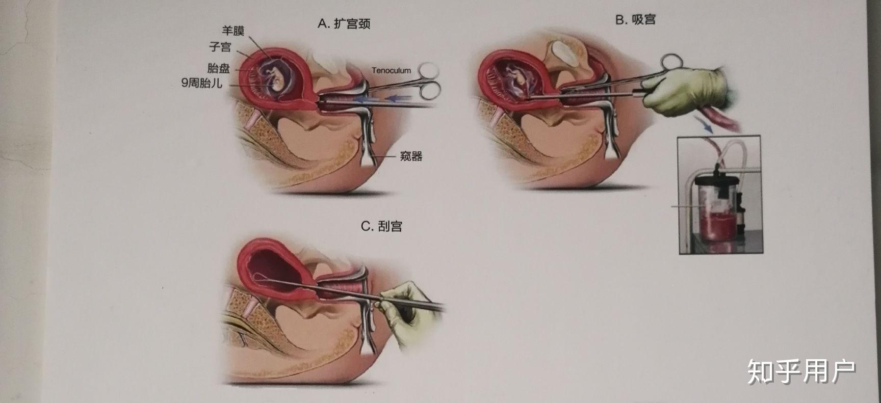 经历无痛人流全过程及术后会有什么感想