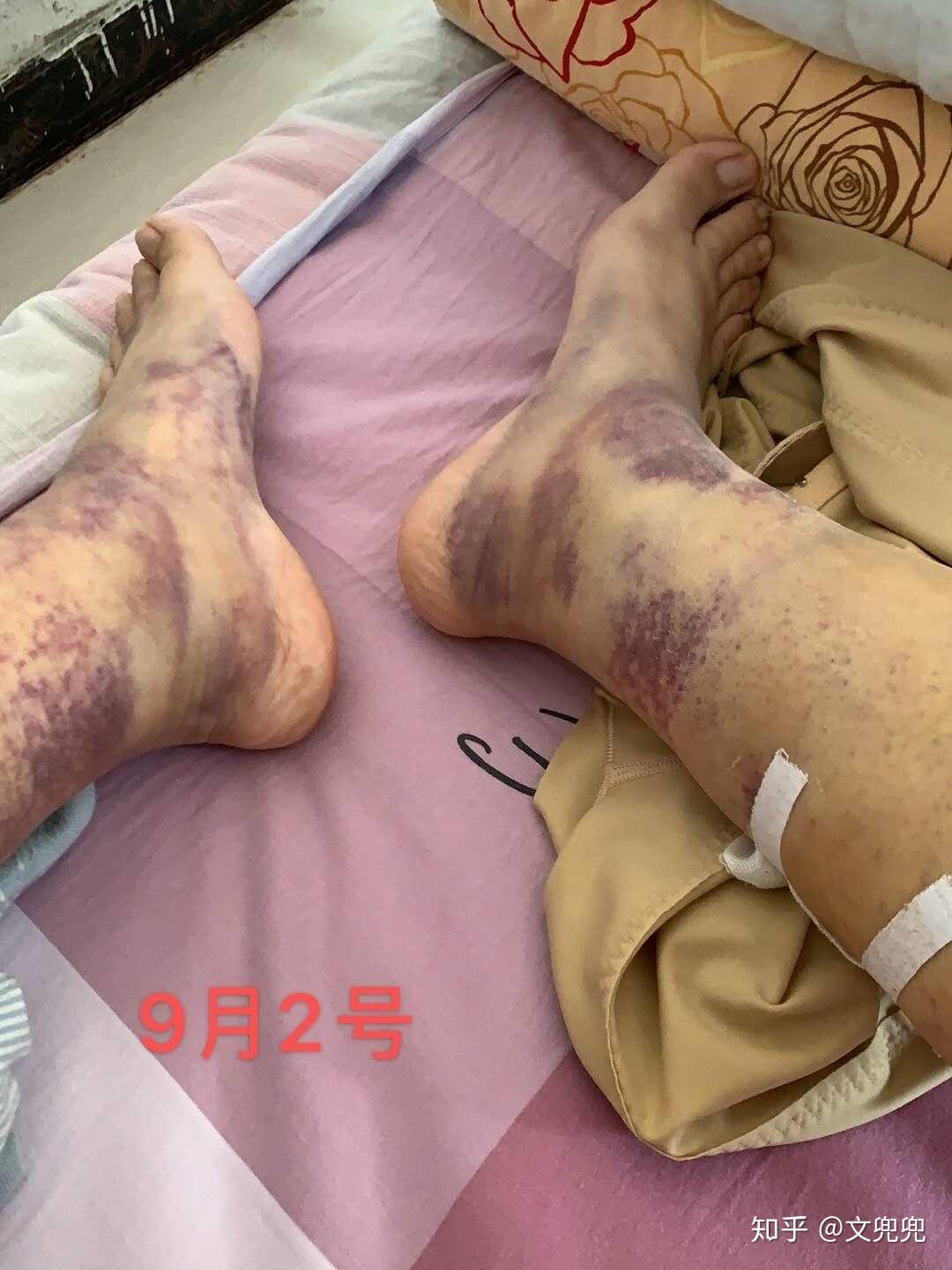 大腿小腿抽脂,抽了大概4000ml,效果还不错 - 知乎