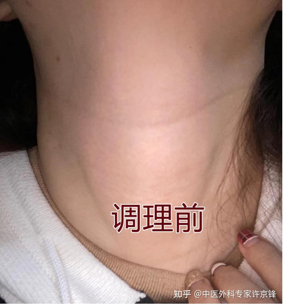 患有甲状腺结节的朋友看过来2个多月4级到2级了