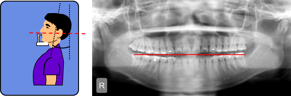伯爵cbct影像篇③口腔全景片认知