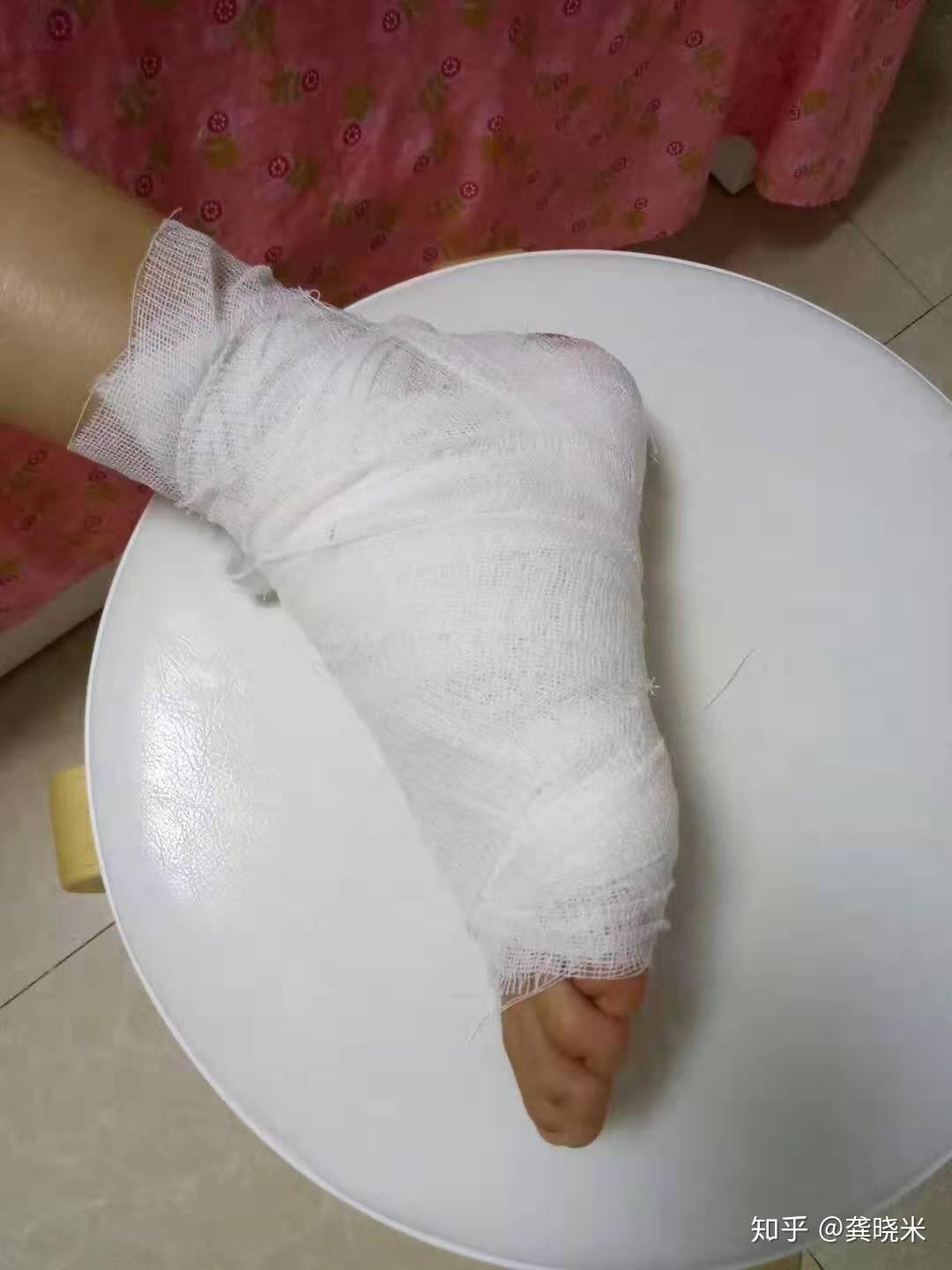 打球崴脚了怎么办? - 知乎