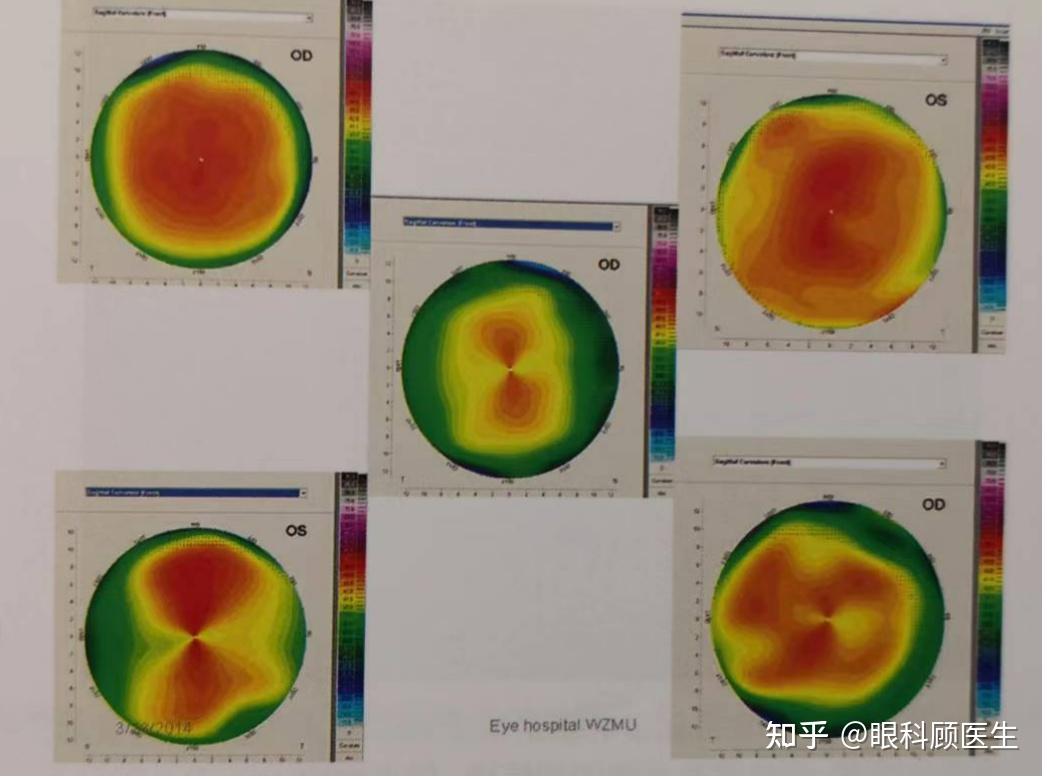 角膜地形图ks和kf图片