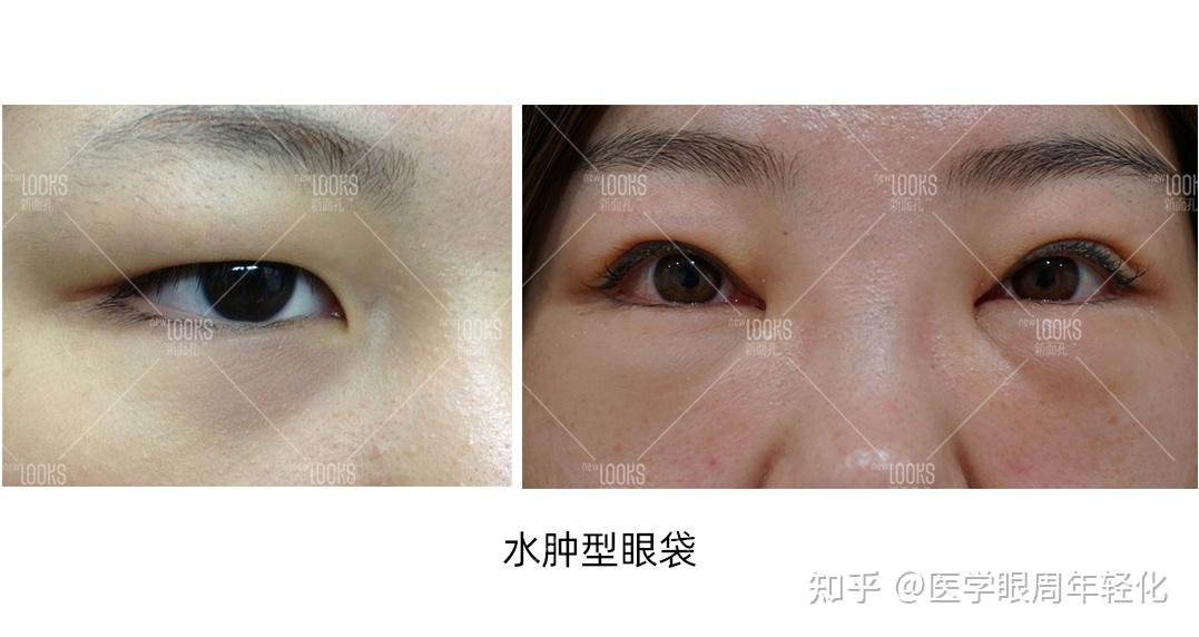 假性眼袋