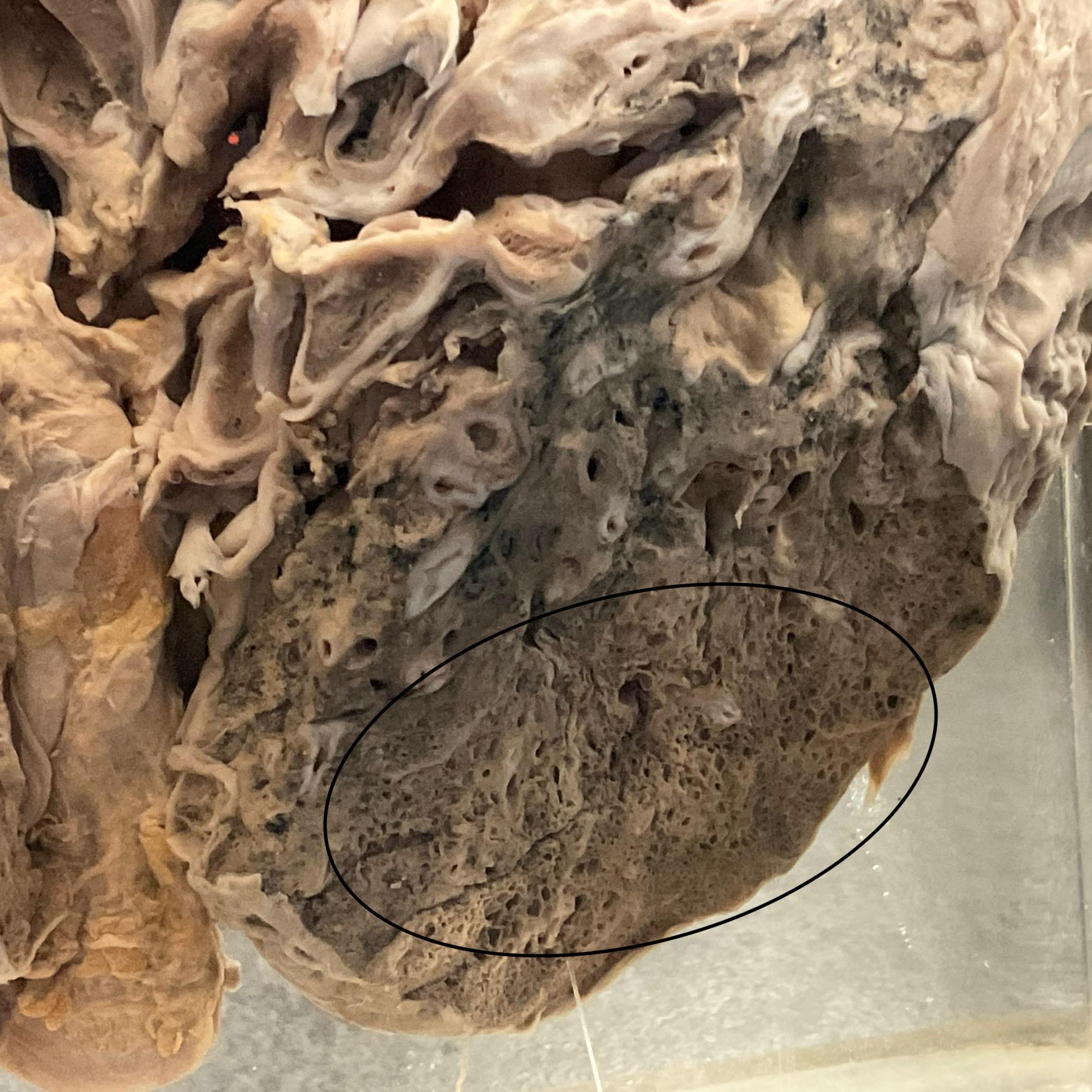 肺病理诊断:肺癌(周边)及淋巴结转移癌观察要点:于左肺切面下叶上端近