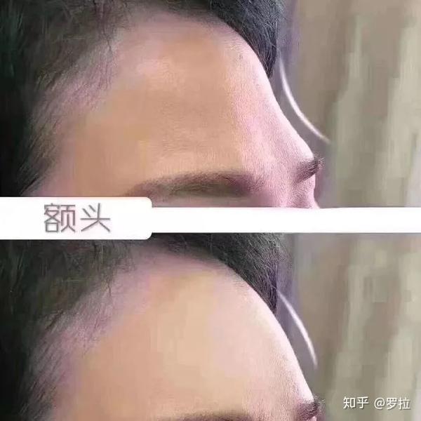 长辈都喜欢额头饱满,显得有福气;网红喜欢填充额头,显得幼齿可爱.