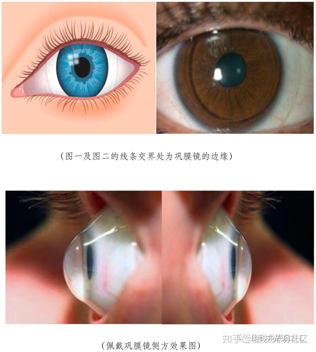 角膜接触镜在圆锥角膜治疗的临床应用 - 知乎