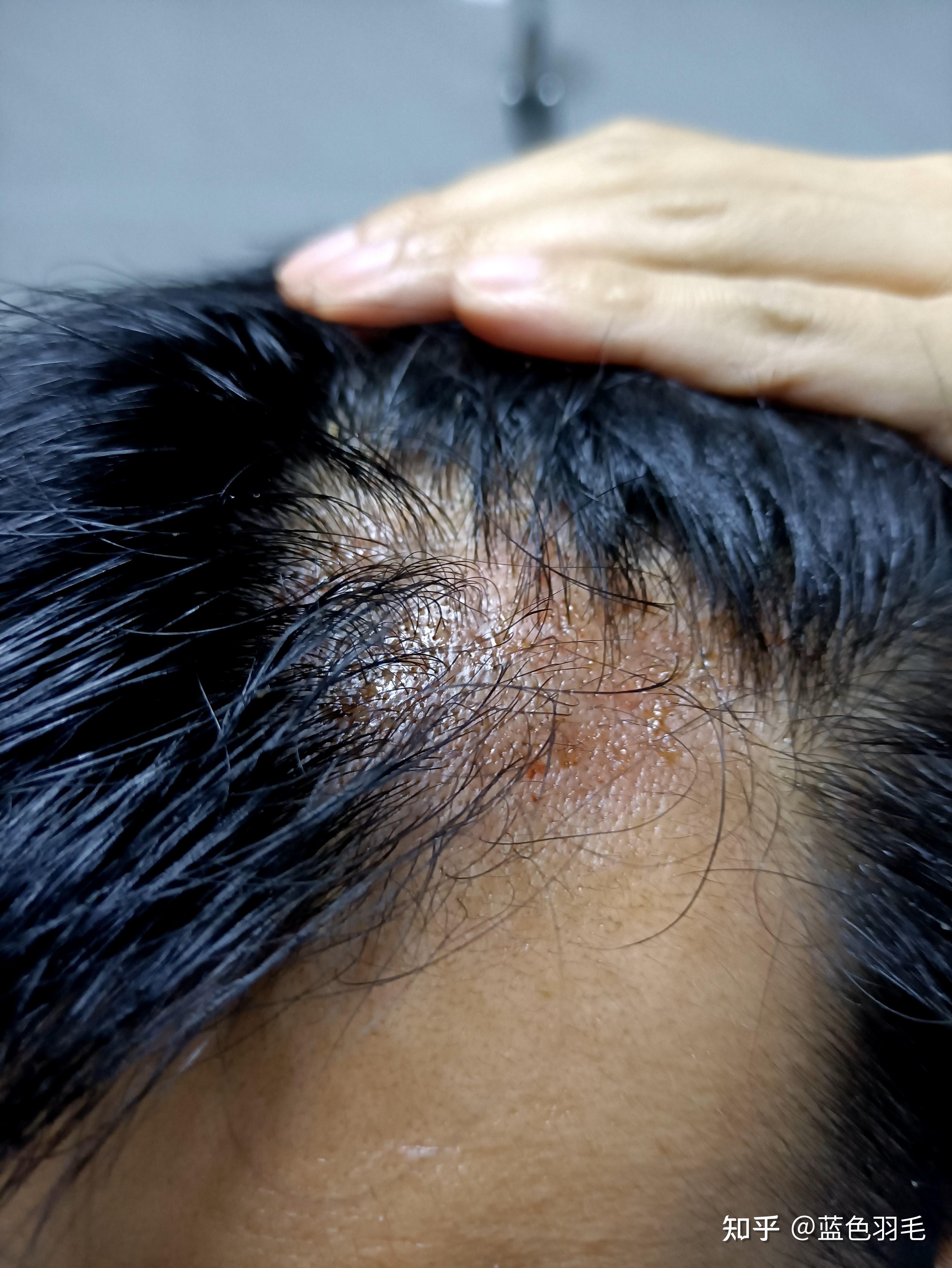 滚轮微针治疗脱发,全程记录,更新至2023.7.