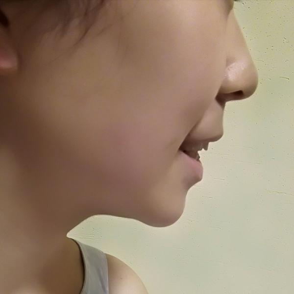 想整牙,但是又很犹豫,小时候睡觉喜欢吃手把牙齿撑龅了,门牙对不起来