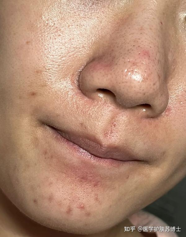 1个月去黑头|【专业医学博士】教你最有效的去黑头方法,当你鼻子两侧被黑头爬满,毛孔也被撑大了,看完这篇彻底解救你的黑头鼻! - 知乎