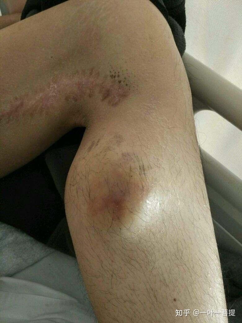 安罗替尼获批治疗软组织肉瘤医保可报销价格多少钱疗效怎么样