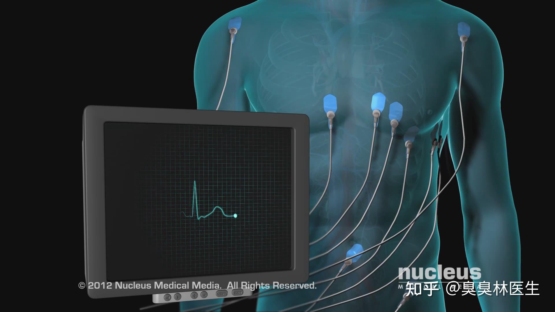 什么人需要心脏起搏器?它是怎么工作的?