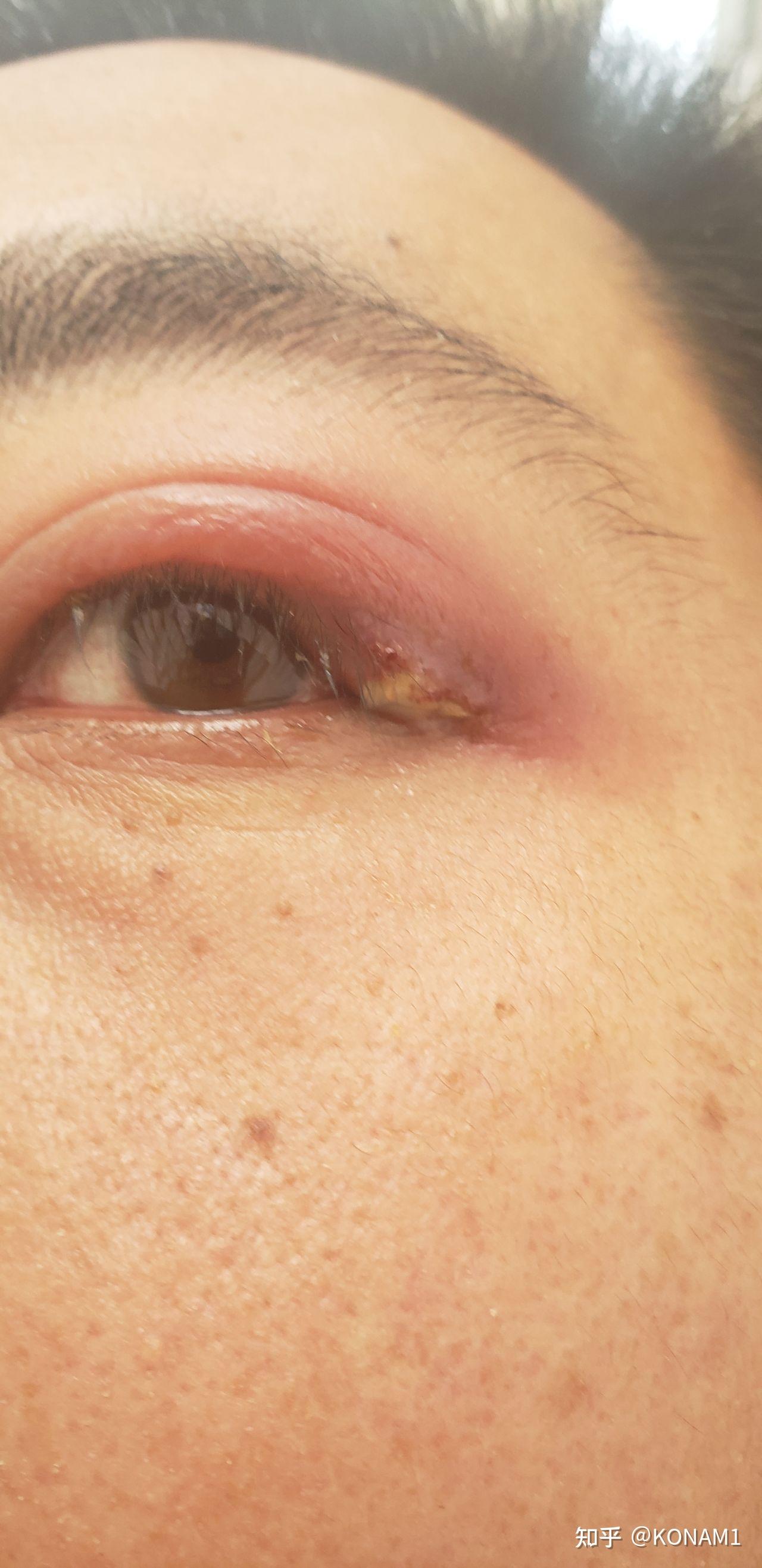 麦粒肿的自愈之路 - 知乎