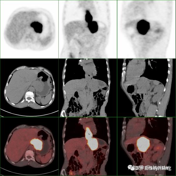 一文通读解析PET-CT检查所有注意事项、放射性危害及典型教学病例一例 - 知乎