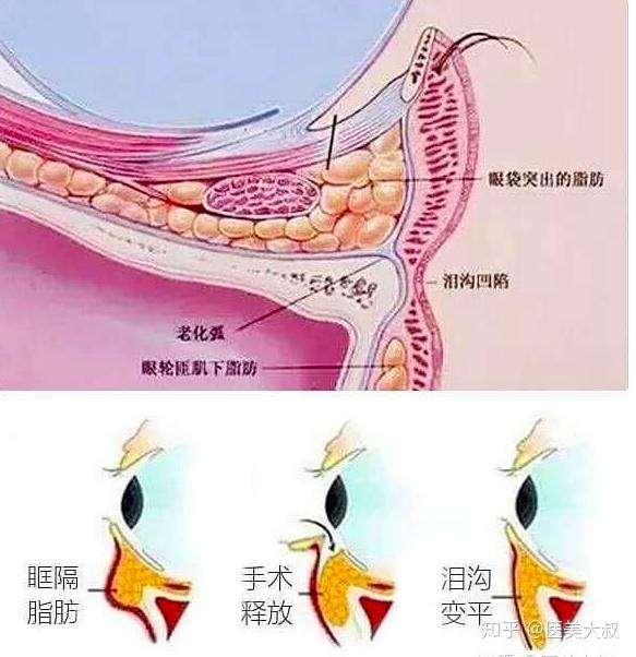 3,松弛型眼袋单纯性下睑及外眦皮肤松弛,但无眶膈松弛,所以无眶隔脂肪