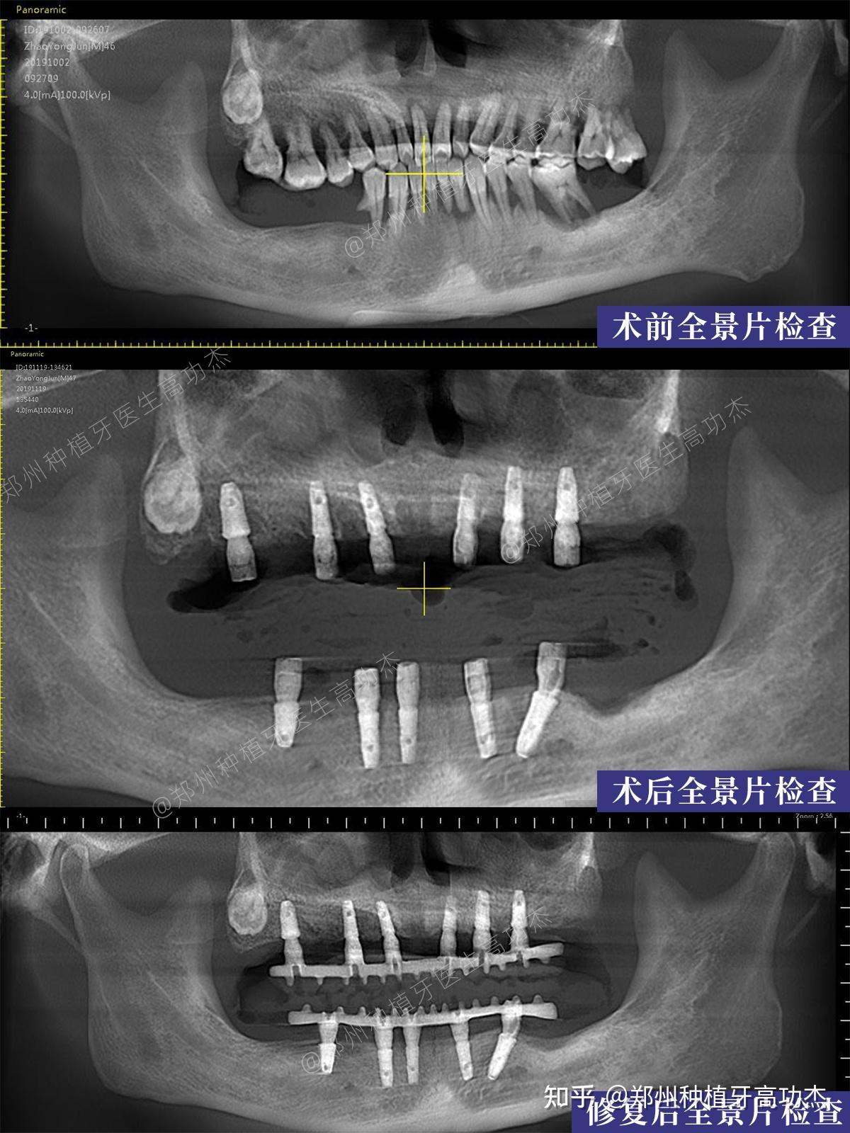 鄭州種植牙鄭州種牙全口即刻種植即刻修復案例分享