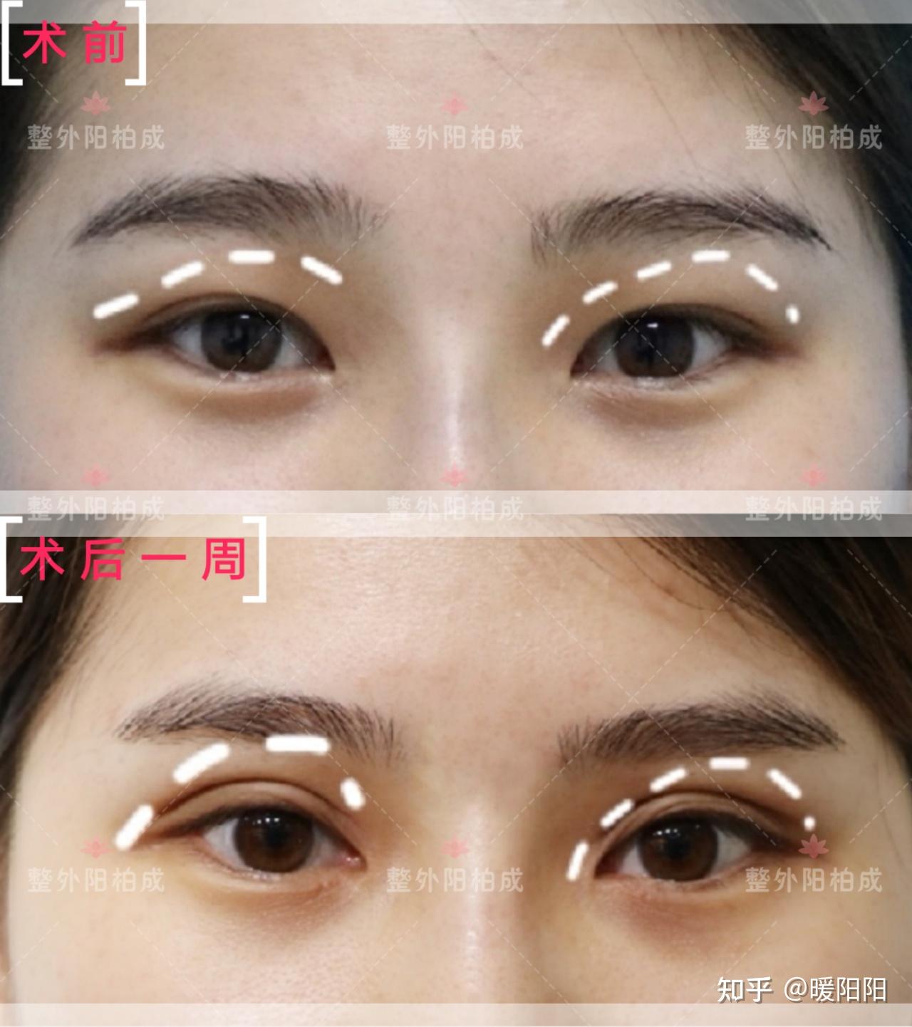 七毫米的双眼皮宽不宽呀?